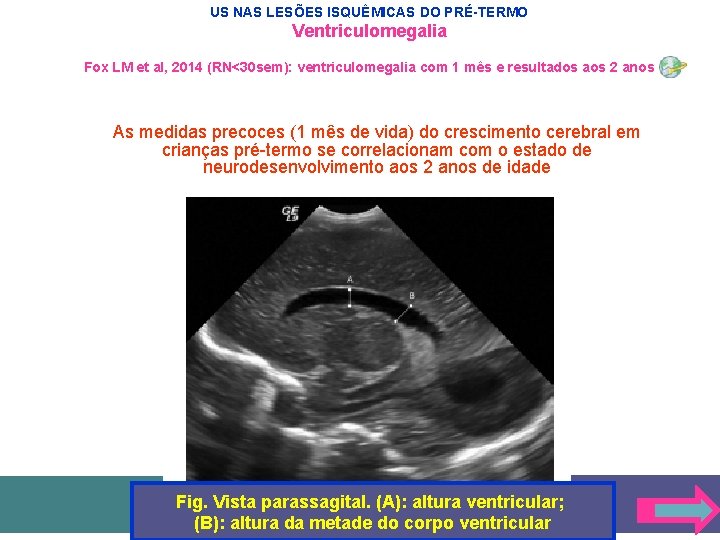 US NAS LESÕES ISQUÊMICAS DO PRÉ-TERMO Ventriculomegalia Fox LM et al, 2014 (RN<30 sem):