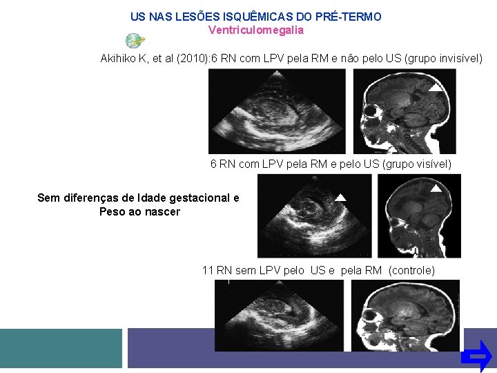 US NAS LESÕES ISQUÊMICAS DO PRÉ-TERMO Ventriculomegalia Akihiko K, et al (2010): 6 RN