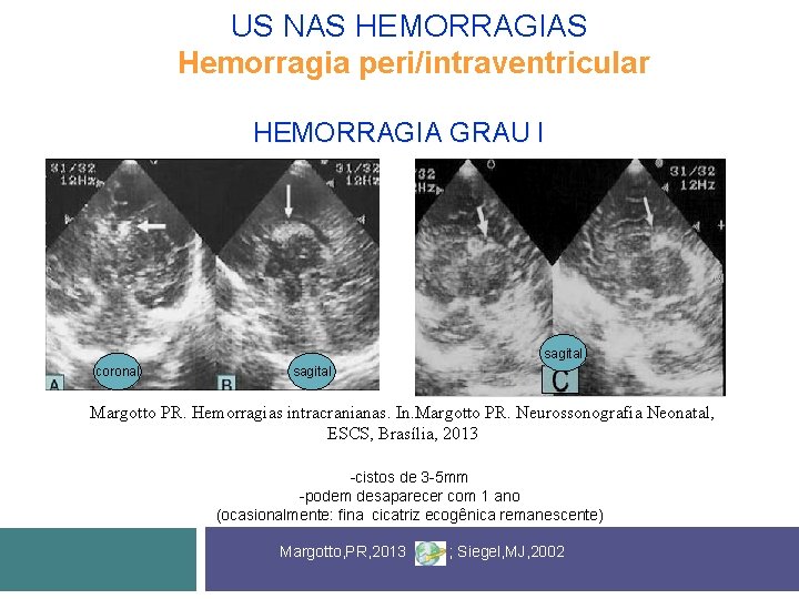 US NAS HEMORRAGIAS Hemorragia peri/intraventricular HEMORRAGIA GRAU I sagital coronal sagital Margotto PR. Hemorragias