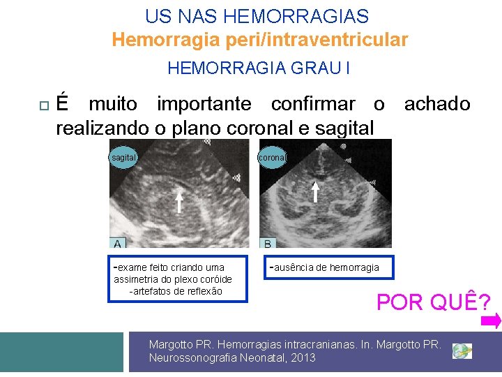 US NAS HEMORRAGIAS Hemorragia peri/intraventricular HEMORRAGIA GRAU I É muito importante confirmar o achado