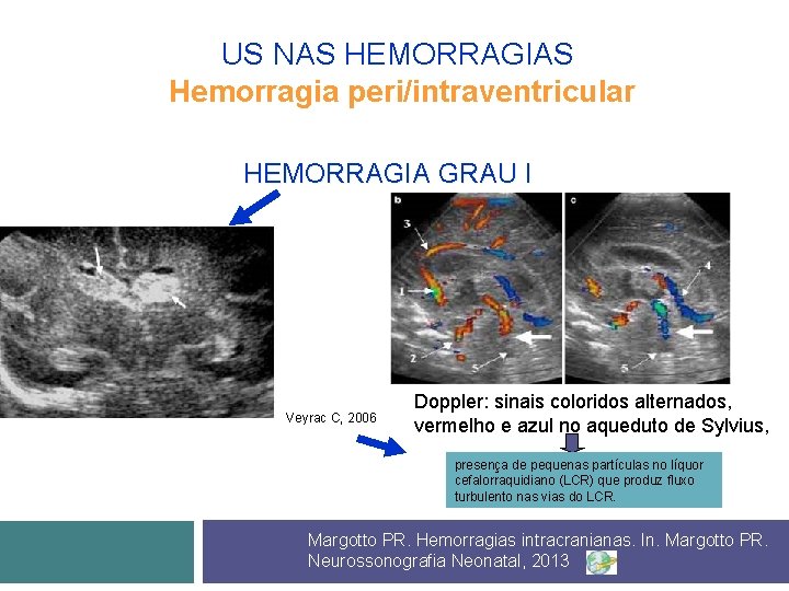 US NAS HEMORRAGIAS Hemorragia peri/intraventricular HEMORRAGIA GRAU I Veyrac C, 2006 Doppler: sinais coloridos