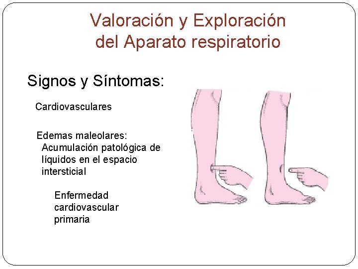 Valoración y Exploración del Aparato respiratorio Signos y Síntomas: Cardiovasculares Edemas maleolares: Acumulación patológica