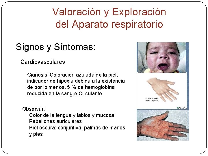 Valoración y Exploración del Aparato respiratorio Signos y Síntomas: Cardiovasculares Cianosis. Coloración azulada de