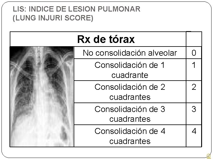 LIS: INDICE DE LESION PULMONAR (LUNG INJURI SCORE) Rx de tórax No consolidación alveolar