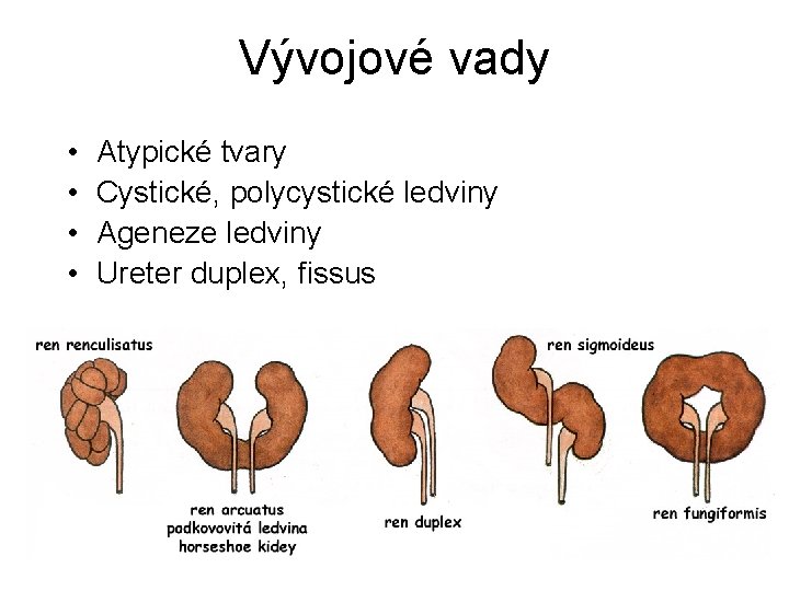 Vývojové vady • • Atypické tvary Cystické, polycystické ledviny Ageneze ledviny Ureter duplex, fissus
