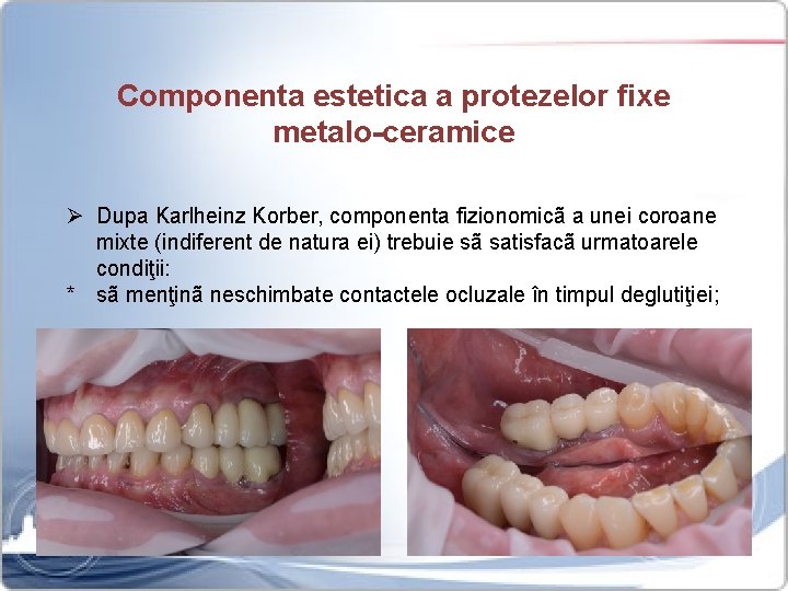 Componenta estetica a protezelor fixe metalo-ceramice Ø Dupa Karlheinz Korber, componenta fizionomicã a unei