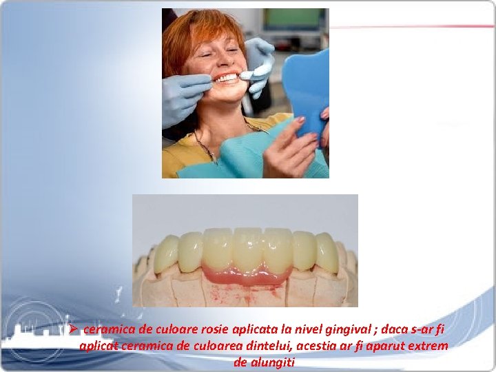 Ø ceramica de culoare rosie aplicata la nivel gingival ; daca s-ar fi aplicat