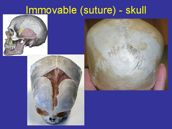 Immovable (suture) - skull 