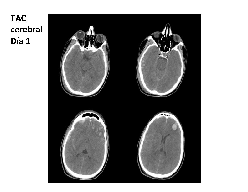 TAC cerebral Día 1 