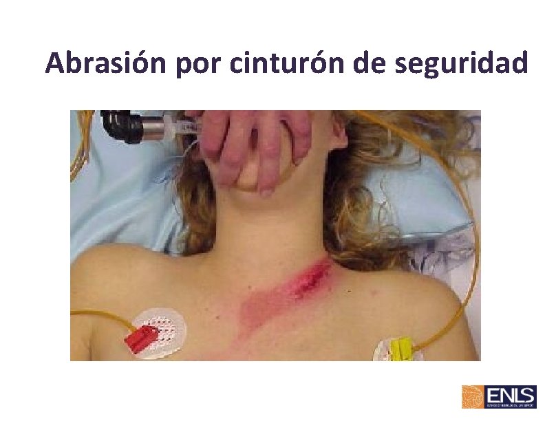 Abrasión por cinturón de seguridad 