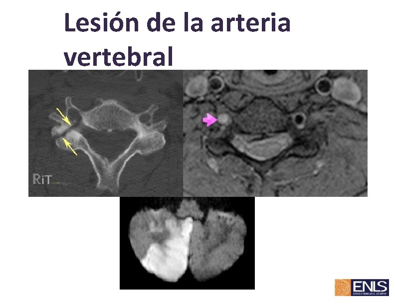 Lesión de la arteria vertebral 