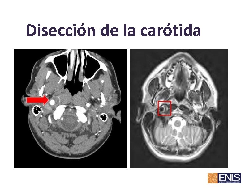 Disección de la carótida 