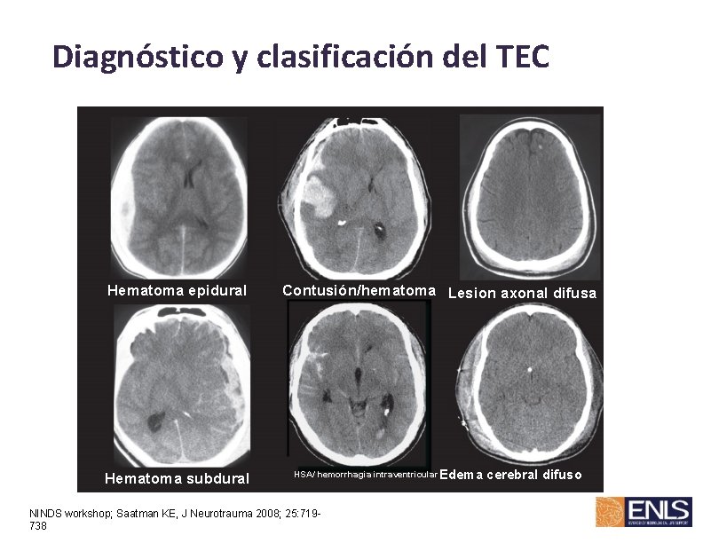 Diagnóstico y clasificación del TEC Hematoma epidural Hematoma subdural Contusión/hematoma Lesion axonal difusa HSA/