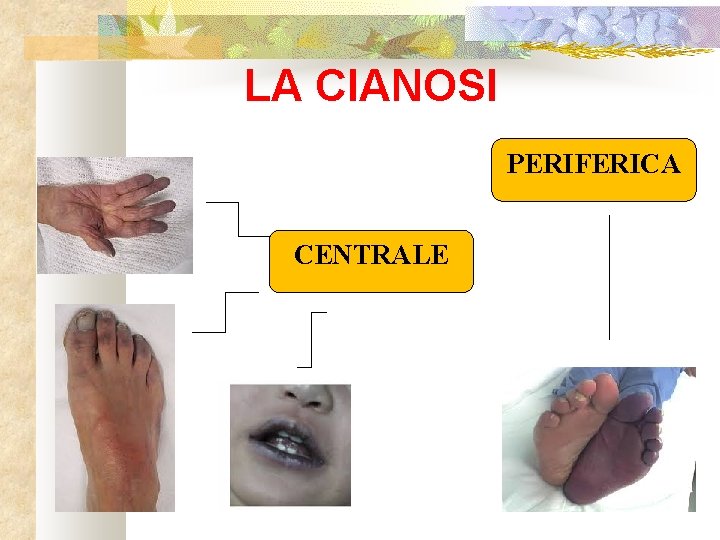 LA CIANOSI PERIFERICA CENTRALE 