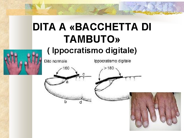 DITA A «BACCHETTA DI TAMBUTO» ( Ippocratismo digitale) 