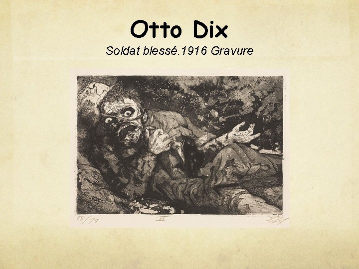 Otto Dix Soldat blessé. 1916 Gravure 