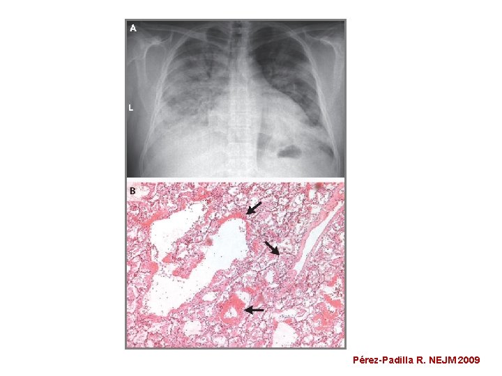 Pérez-Padilla R. NEJM 2009 