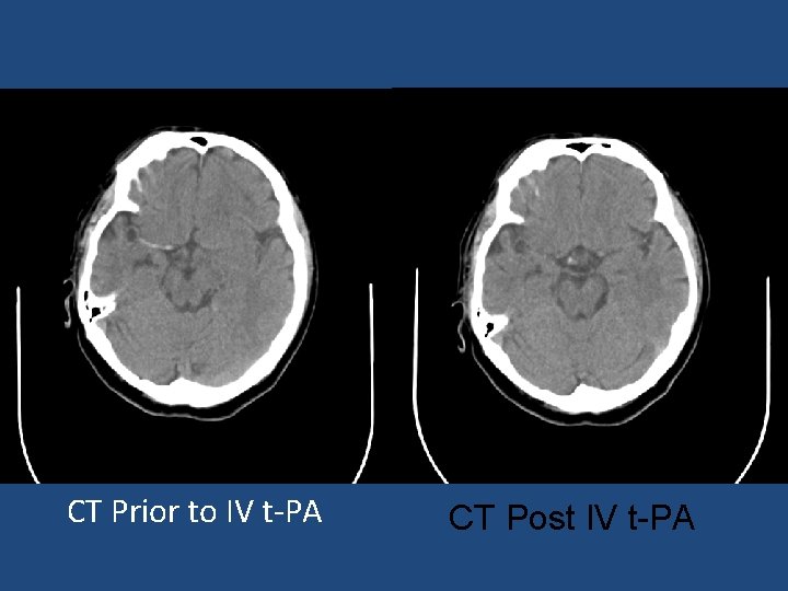 CT Prior to IV t PA CT Post IV t-PA 