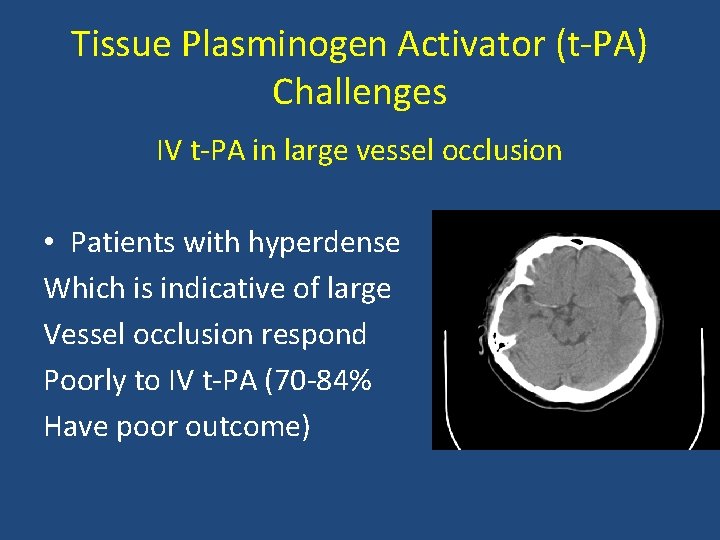 Tissue Plasminogen Activator (t PA) Challenges IV t PA in large vessel occlusion •