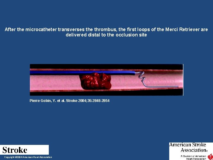 After the microcatheter transverses the thrombus, the first loops of the Merci Retriever are