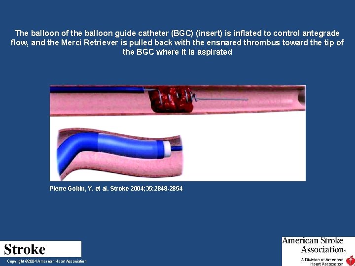 The balloon of the balloon guide catheter (BGC) (insert) is inflated to control antegrade