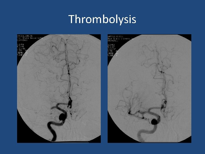 Thrombolysis Thrombolysis
