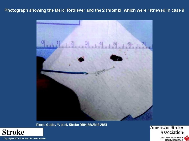 Photograph showing the Merci Retriever and the 2 thrombi, which were retrieved in case Photograph showing the Merci Retriever and the 2 thrombi, which were retrieved in case