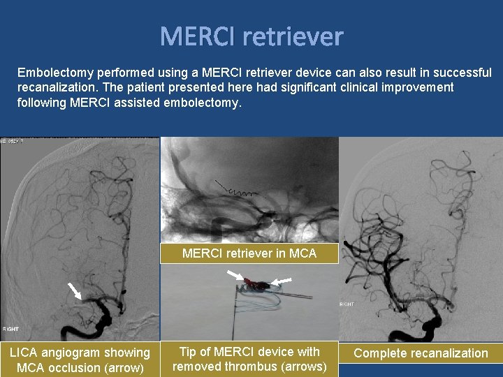 MERCI retriever Embolectomy performed using a MERCI retriever device can also result in successful