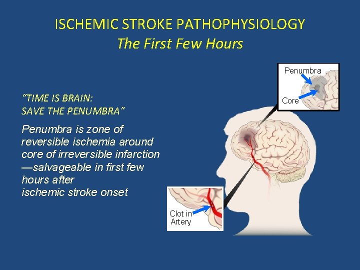 ISCHEMIC STROKE PATHOPHYSIOLOGY The First Few Hours Penumbra “TIME IS BRAIN: SAVE THE PENUMBRA”