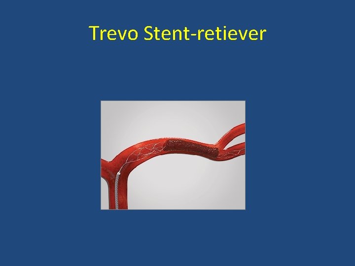 Trevo Stent retiever 