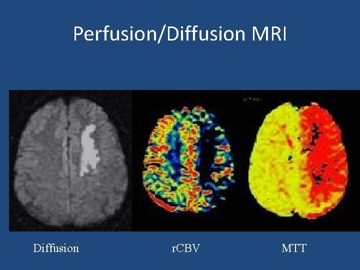 Perfusion/Diffusion MRI Diffusion r. CBV MTT 