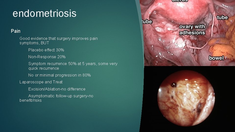 endometriosis Pain Good evidence that surgery improves pain symptoms, BUT Placebo effect 30% Non-Response