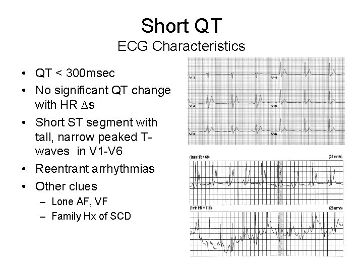 Short QT ECG Characteristics • QT < 300 msec • No significant QT change