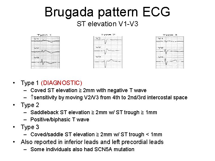Brugada pattern ECG ST elevation V 1 -V 3 • Type 1 (DIAGNOSTIC) –