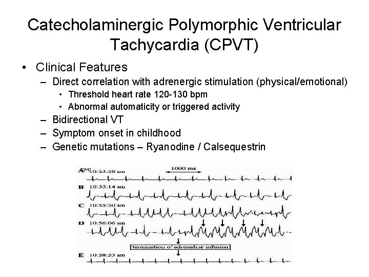 Catecholaminergic Polymorphic Ventricular Tachycardia (CPVT) • Clinical Features – Direct correlation with adrenergic stimulation