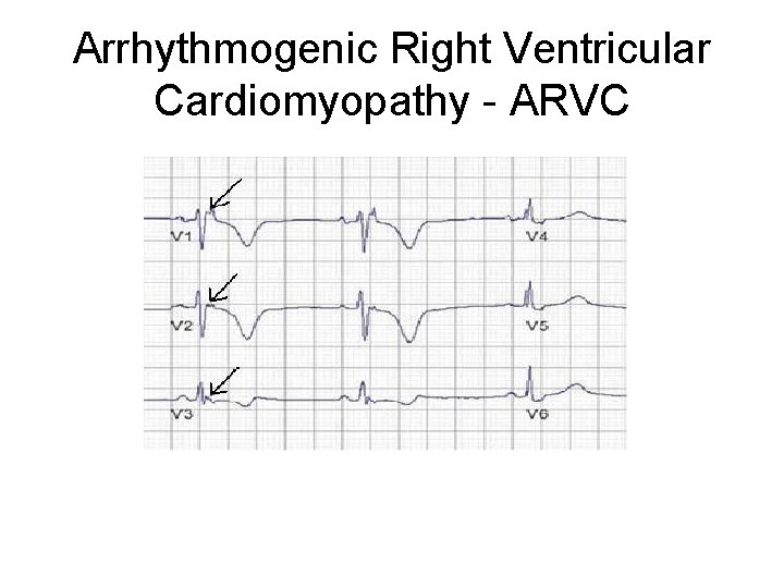 Arrhythmogenic Right Ventricular Cardiomyopathy - ARVC 