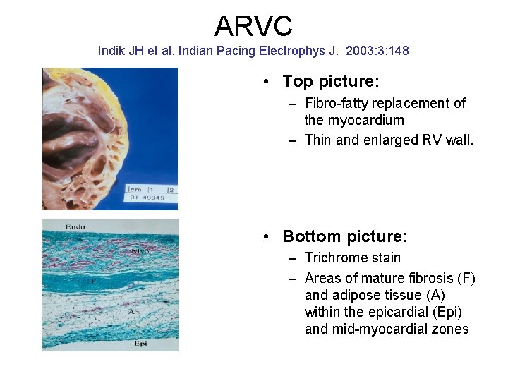 ARVC Indik JH et al. Indian Pacing Electrophys J. 2003: 3: 148 • Top