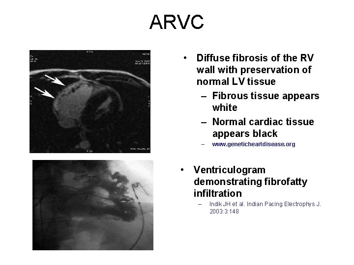 ARVC • Diffuse fibrosis of the RV wall with preservation of normal LV tissue