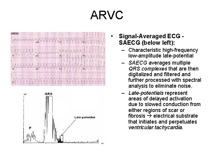 ARVC • Signal-Averaged ECG SAECG (below left): – Characteristic high-frequency low-amplitude late-potential – SAECG