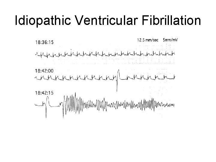 Idiopathic Ventricular Fibrillation 