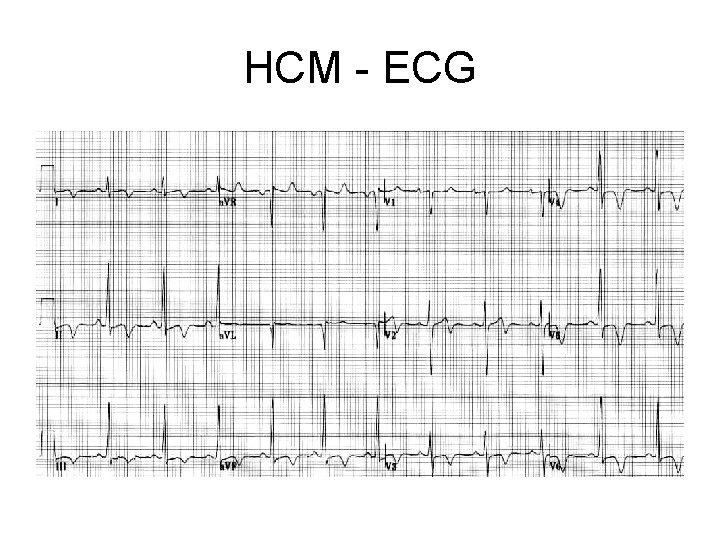 HCM - ECG 