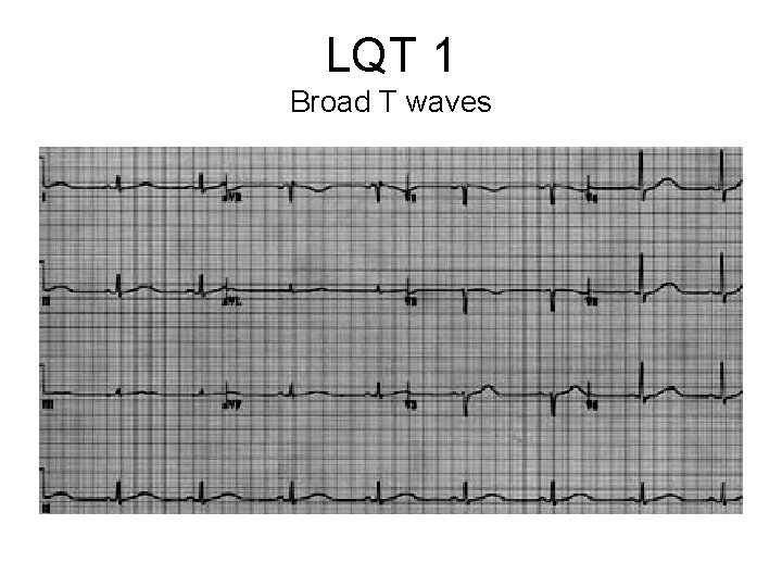 LQT 1 Broad T waves 