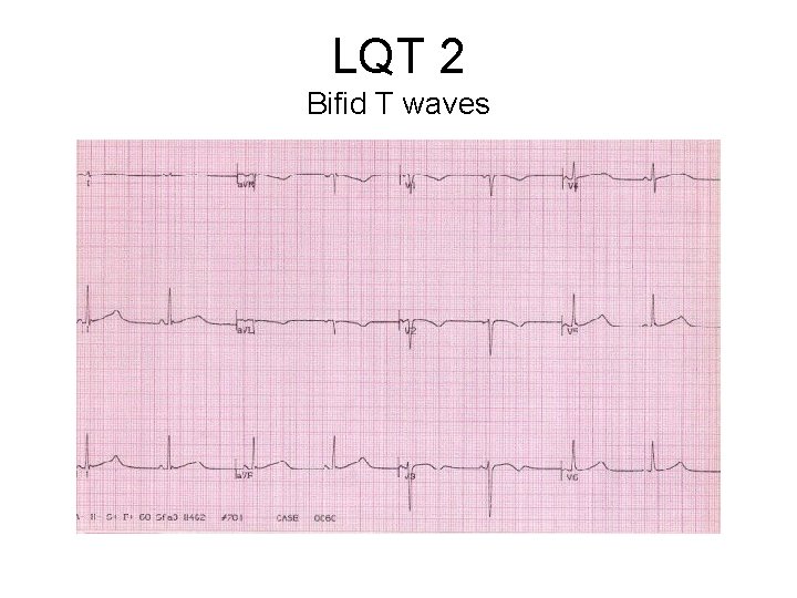 LQT 2 Bifid T waves 