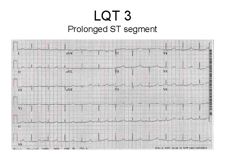LQT 3 Prolonged ST segment 