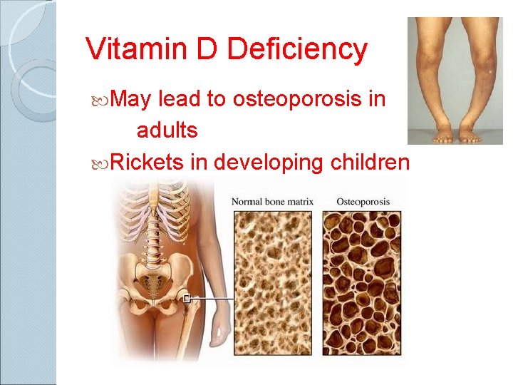 Vitamin D Deficiency May lead to osteoporosis in adults Rickets in developing children 