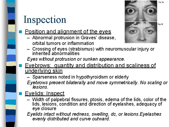 Inspection n Position and alignment of the eyes – Abnormal protrusion in Graves’ disease,