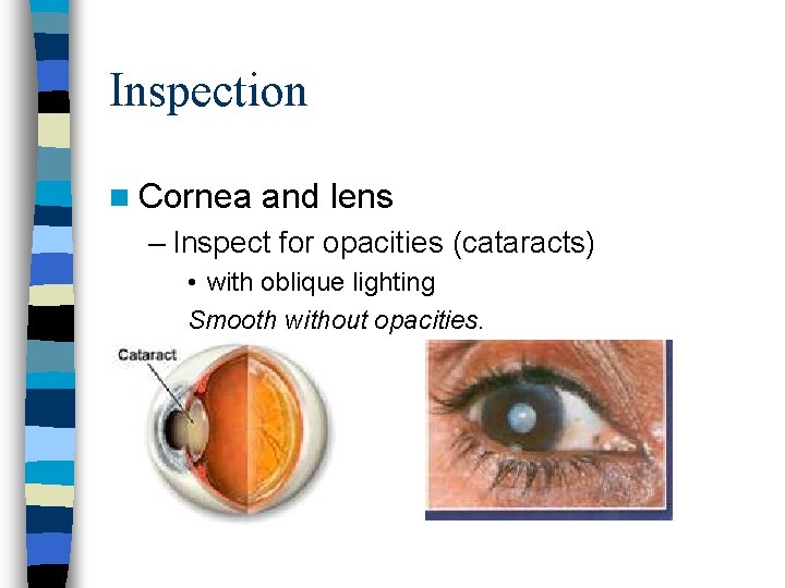 Inspection n Cornea and lens – Inspect for opacities (cataracts) • with oblique lighting