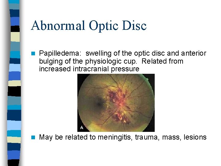 Abnormal Optic Disc n Papilledema: swelling of the optic disc and anterior bulging of