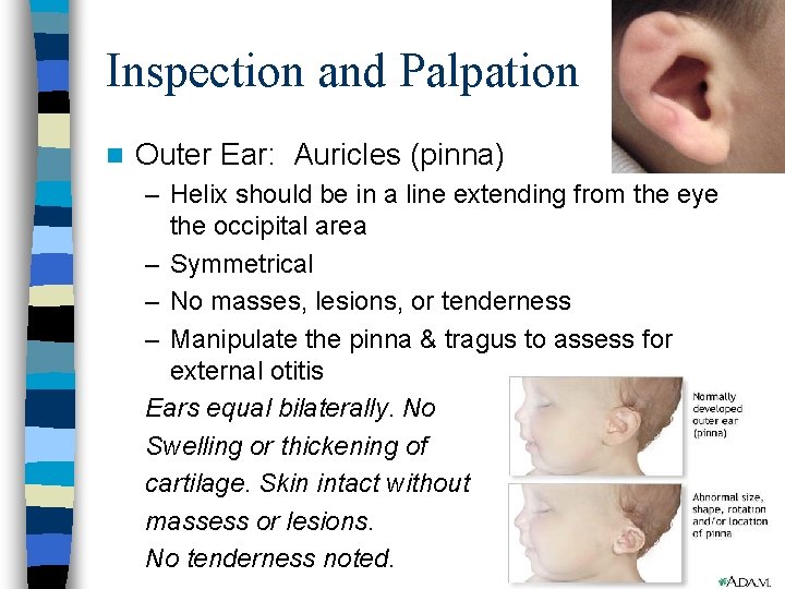 Inspection and Palpation n Outer Ear: Auricles (pinna) – Helix should be in a