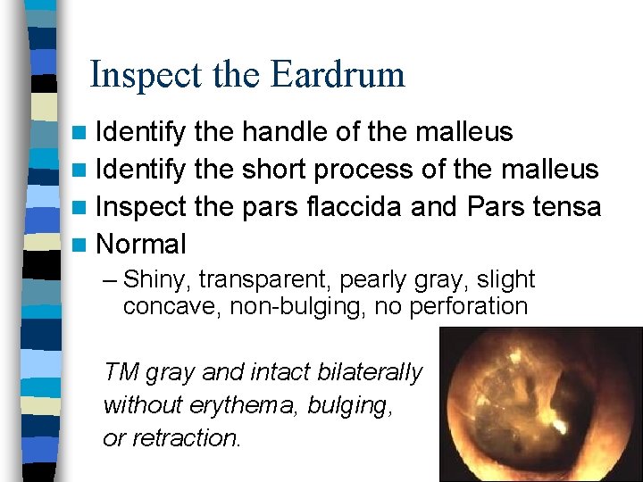 Inspect the Eardrum n Identify the handle of the malleus n Identify the short